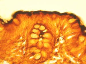 F,52y. | spirochetosis … colon Warthin-Stary silver impregnation